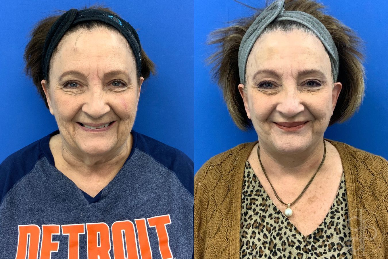 Before and after Facelift case 43472 - Angle 2