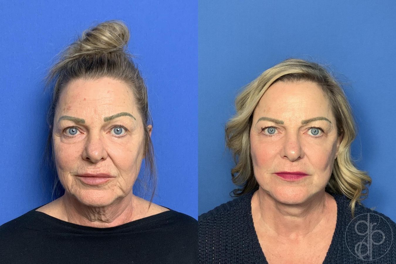 Before and after Facelift case 30003