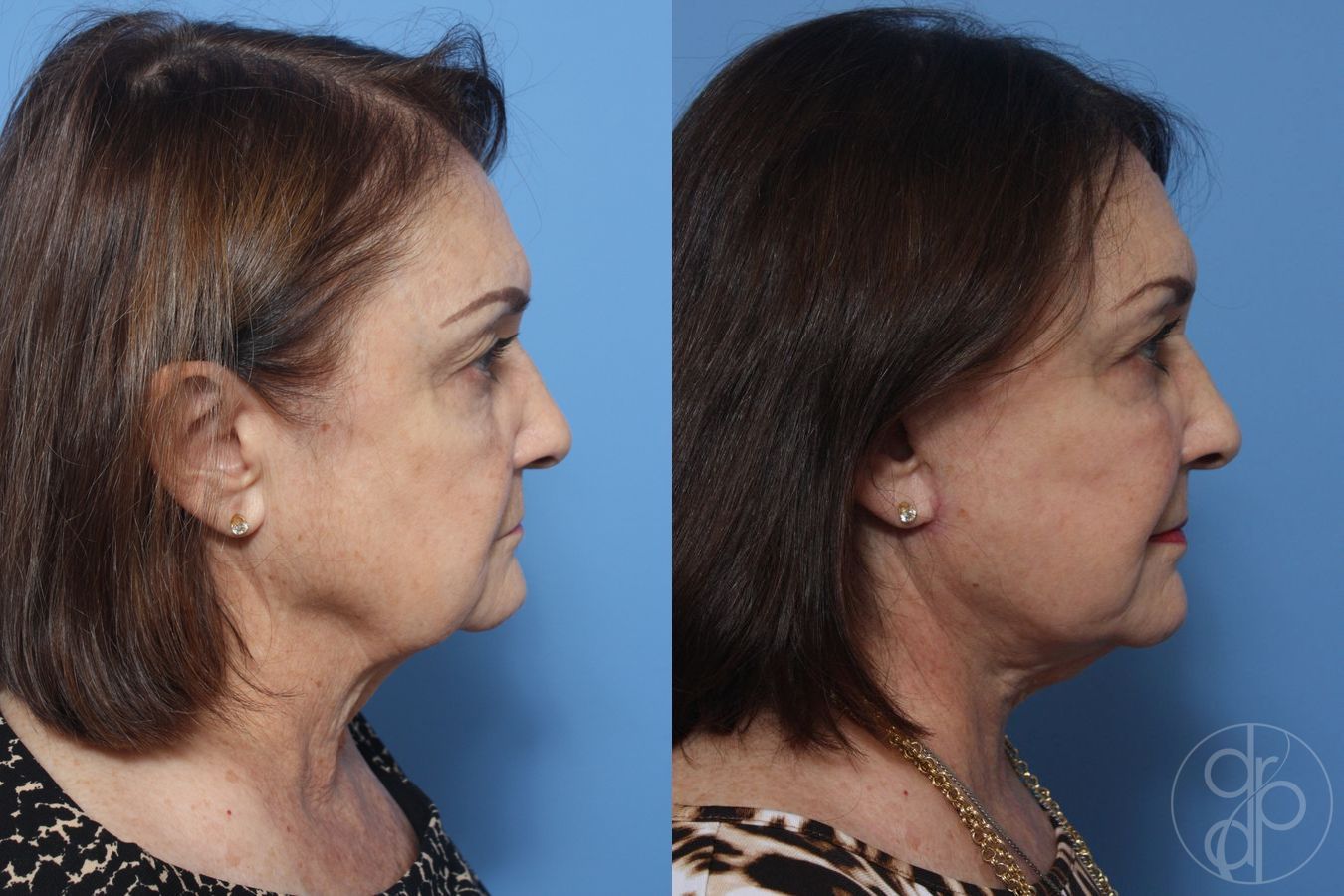 Before and after Facelift case 29843 - Angle 4
