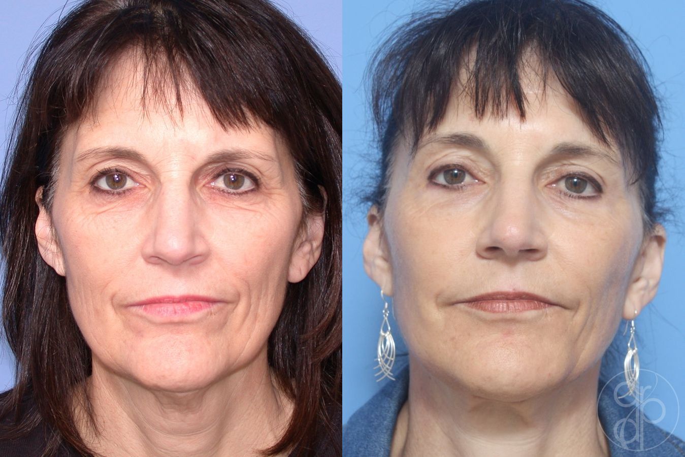 Before and after Facelift case 29813