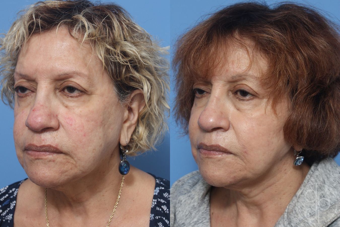 Before and after Facelift case 29842 - Angle 4