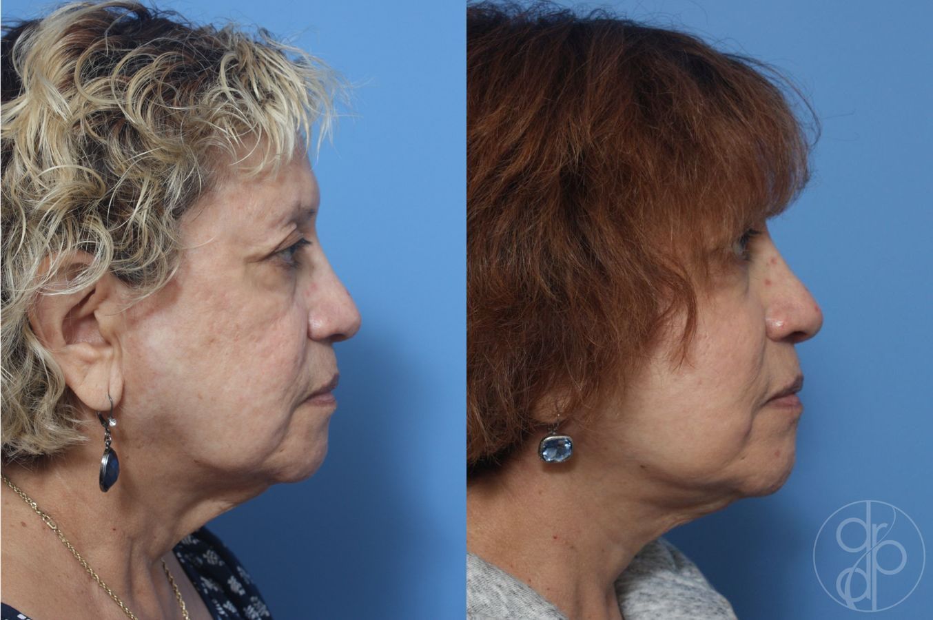 Before and after Facelift case 29842 - Angle 3