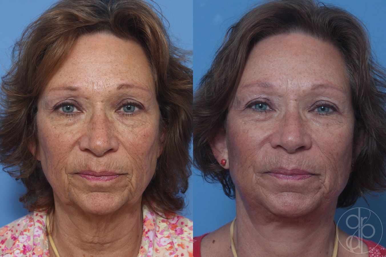 Before and after Facelift case 29840