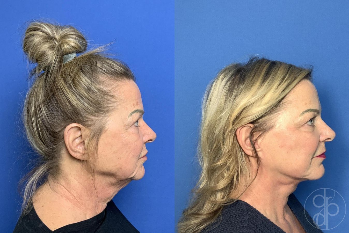 Before and after Facelift case 30003 - Angle 3