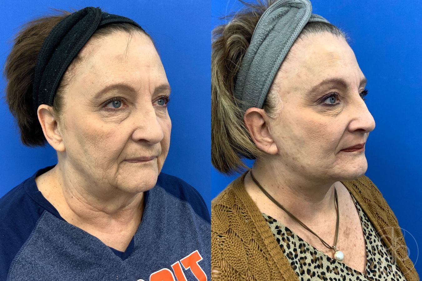 Before and after Facelift case 43472 - Angle 5