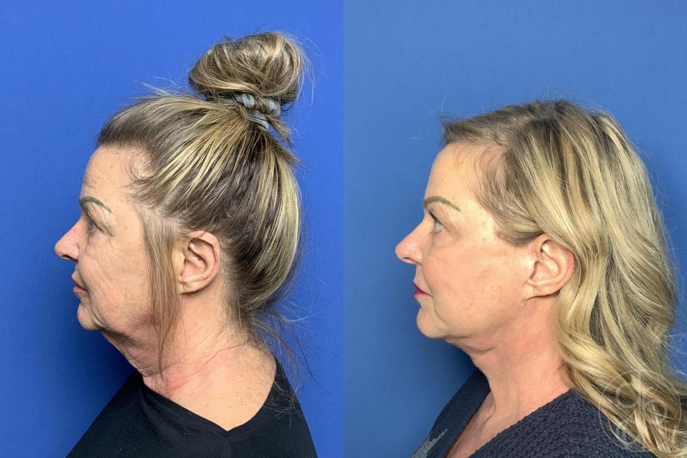 Before and after Facelift case 30003 - Angle 5