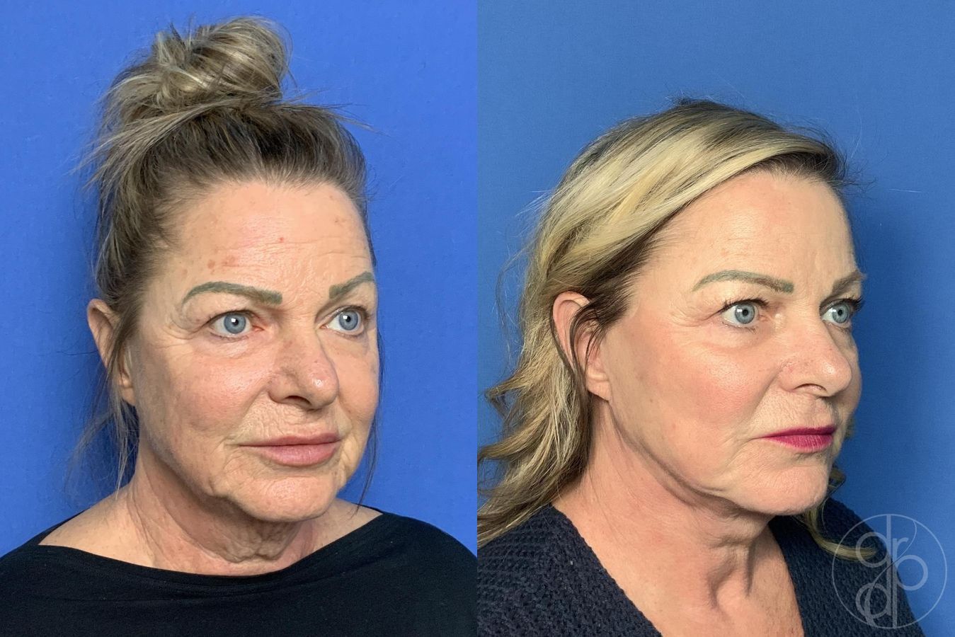 Before and after Facelift case 30003 - Angle 2