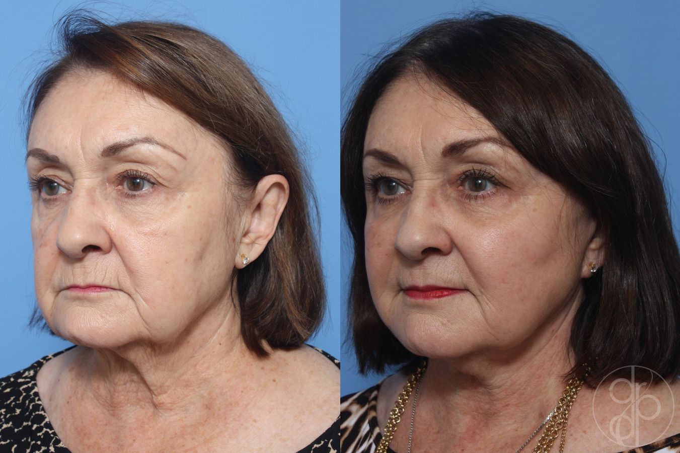 Before and after Facelift case 29843 - Angle 2