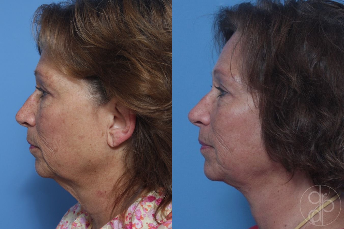 Before and after Facelift case 29840 - Angle 5