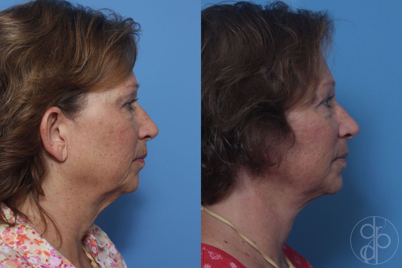 Before and after Facelift case 29840 - Angle 3