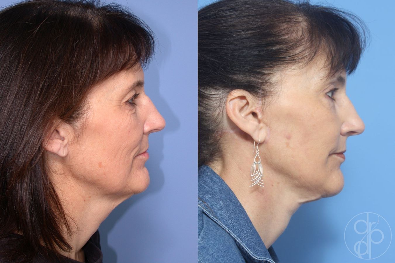 Before and after Blepharoplasty case 29813 - Angle 2