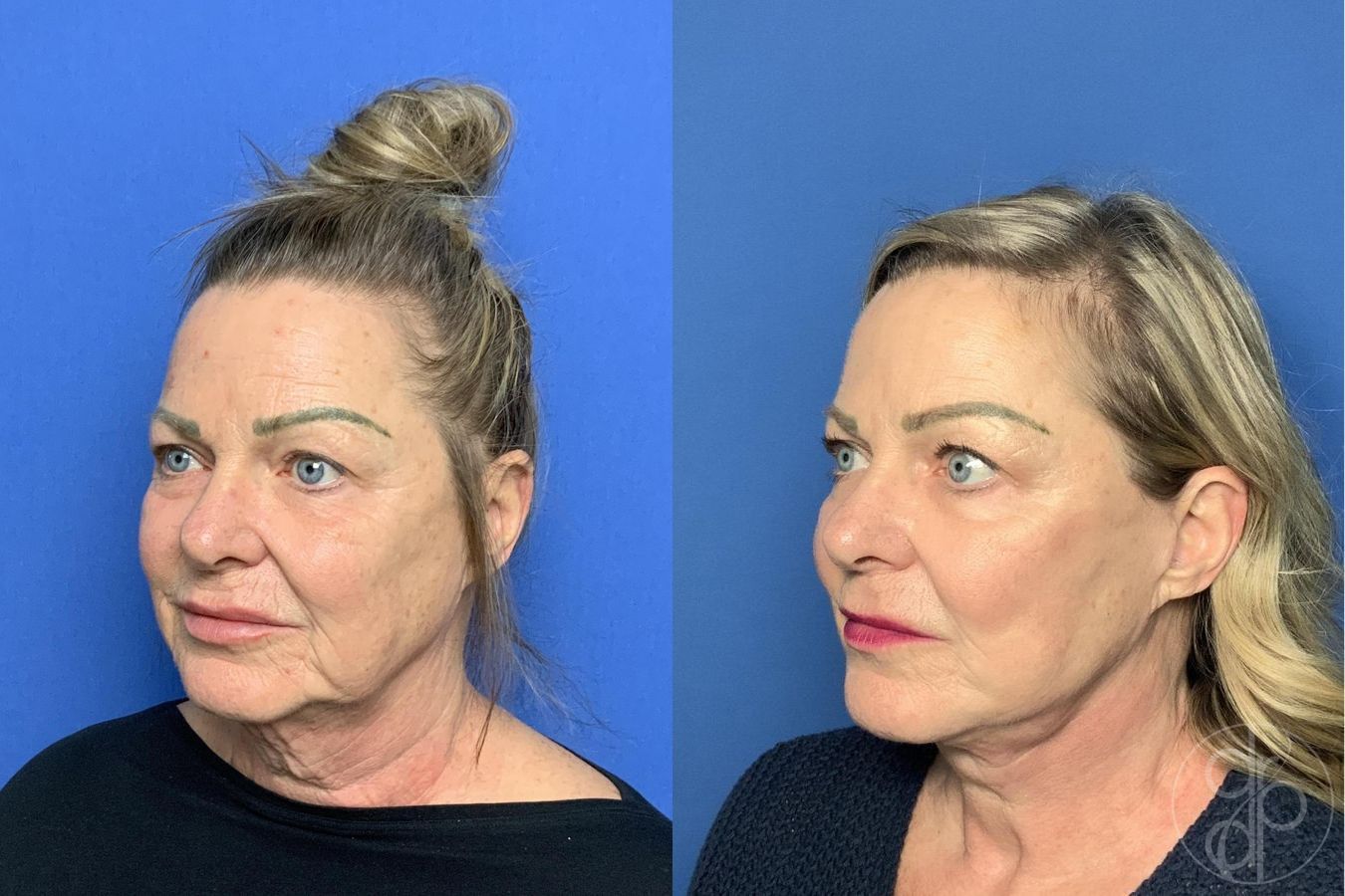Before and after Facelift case 30003 - Angle 4
