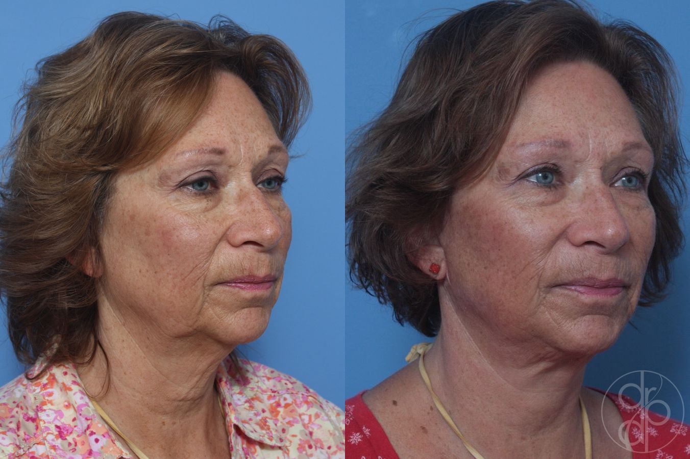 Before and after Facelift case 29840 - Angle 4