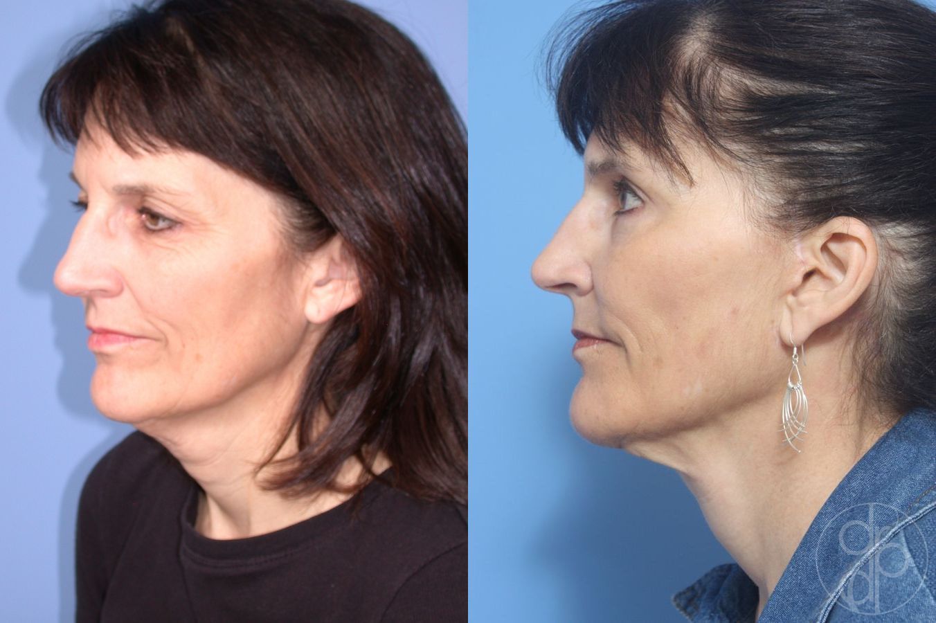 Before and after Facelift case 29813 - Angle 3