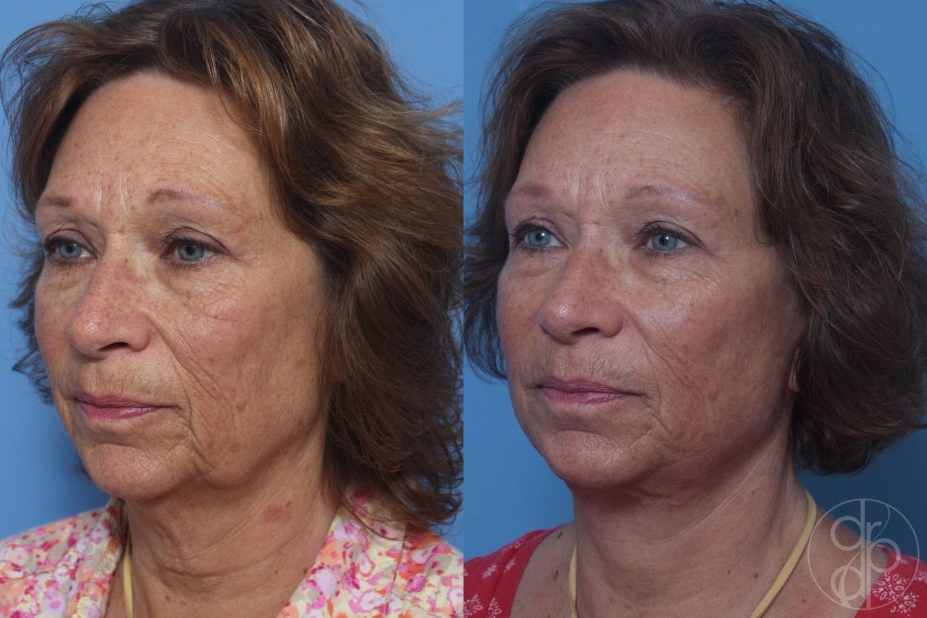 Before and after Facelift case 29840 - Angle 2