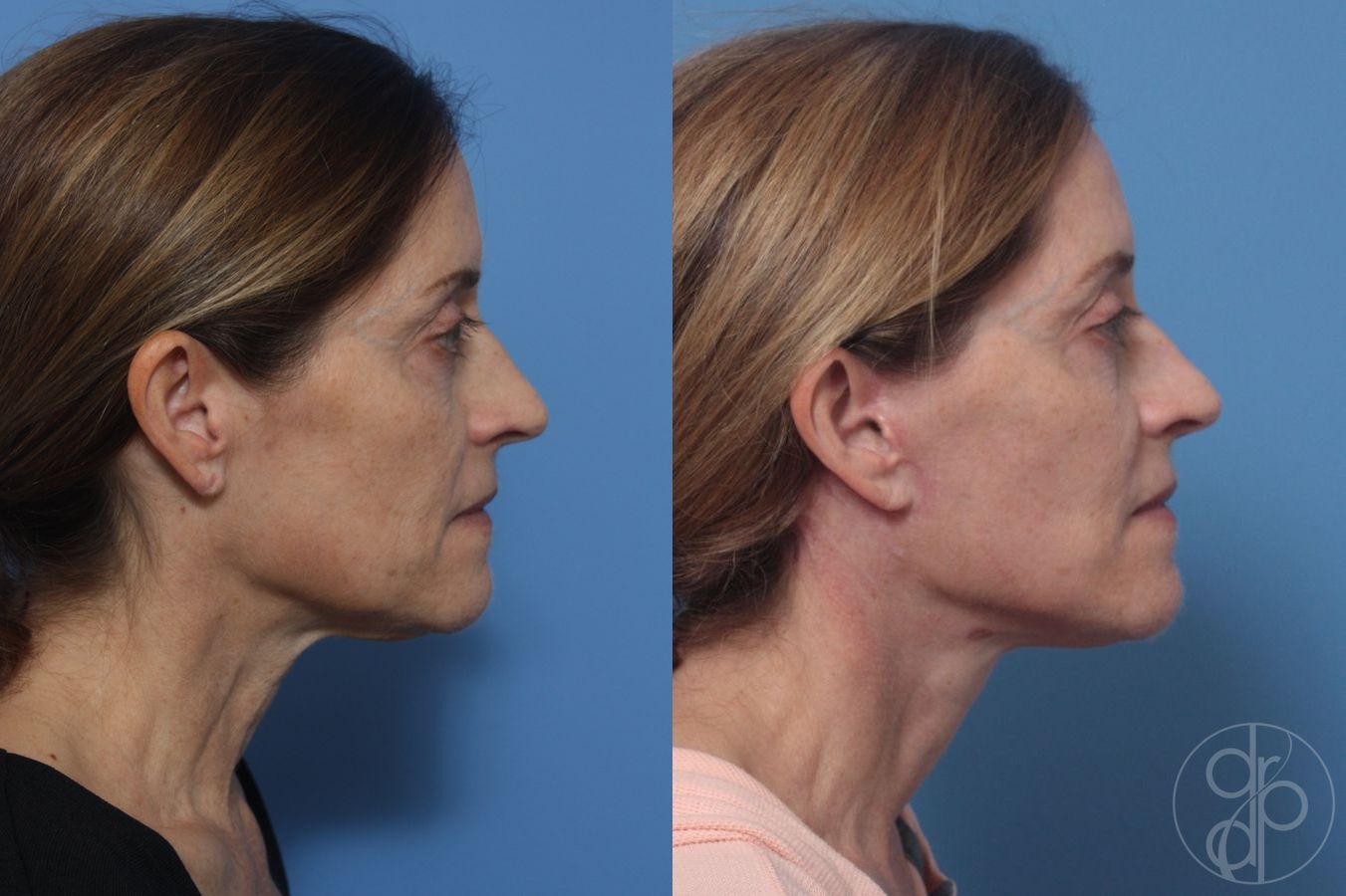 Before and after Facelift case 29824 - Angle 3