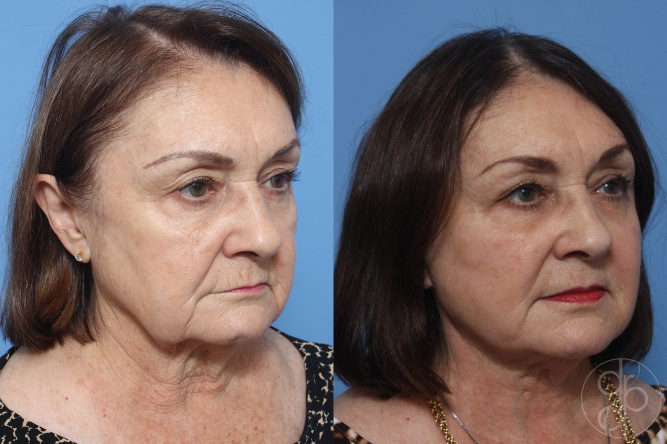 Before and after Facelift case 29843 - Angle 3