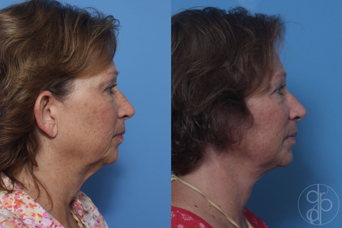 Facelift - Thumbnail 3