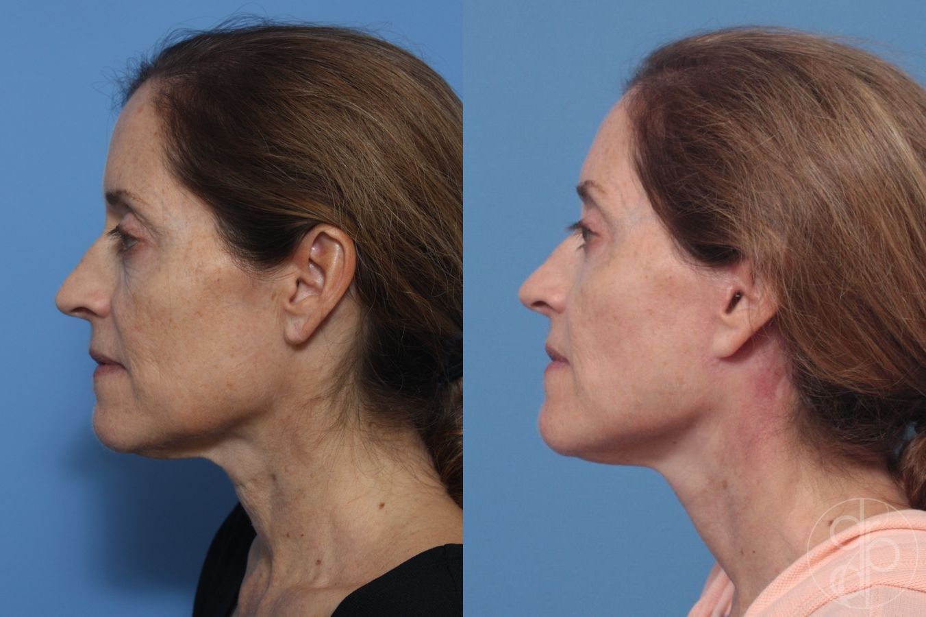 Before and after Facelift case 29824 - Angle 2