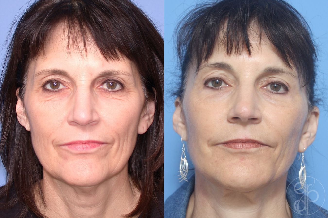 Before and after Blepharoplasty case 29813