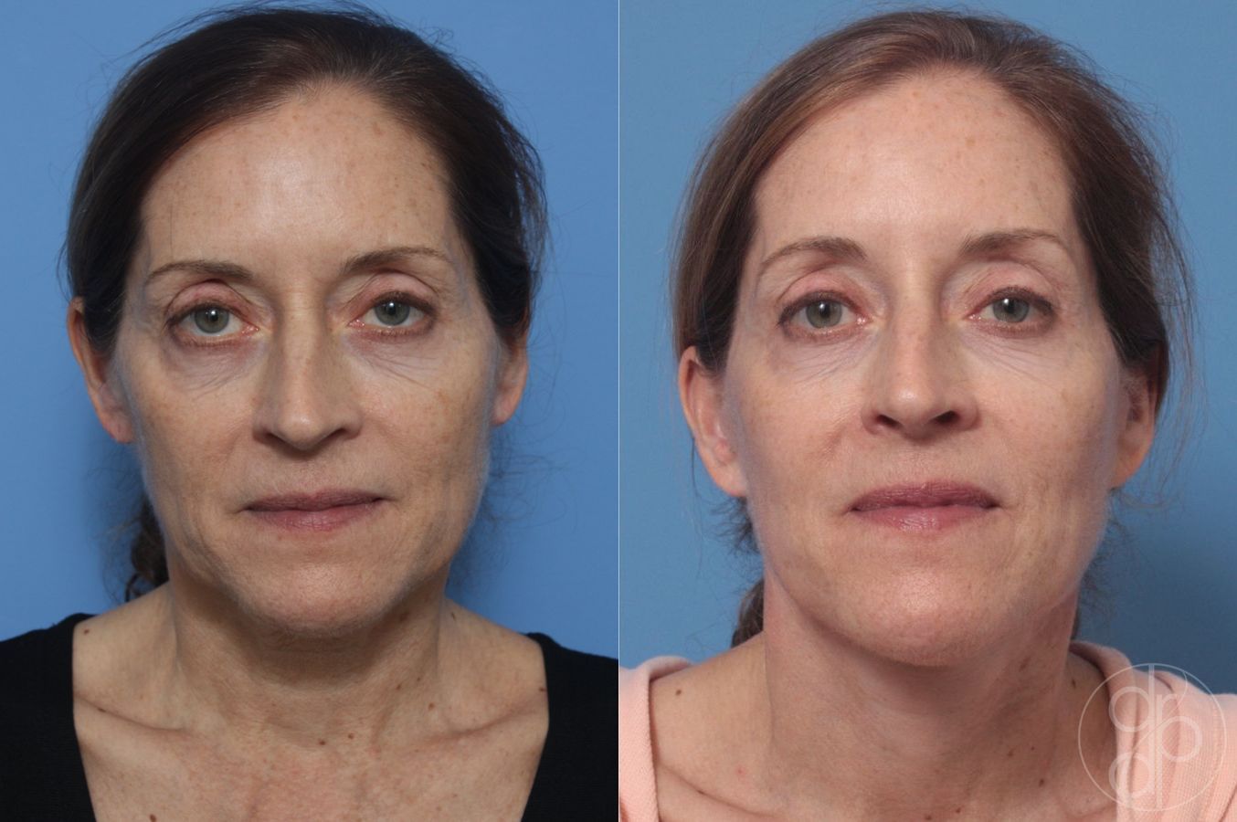 Before and after Facelift case 29824