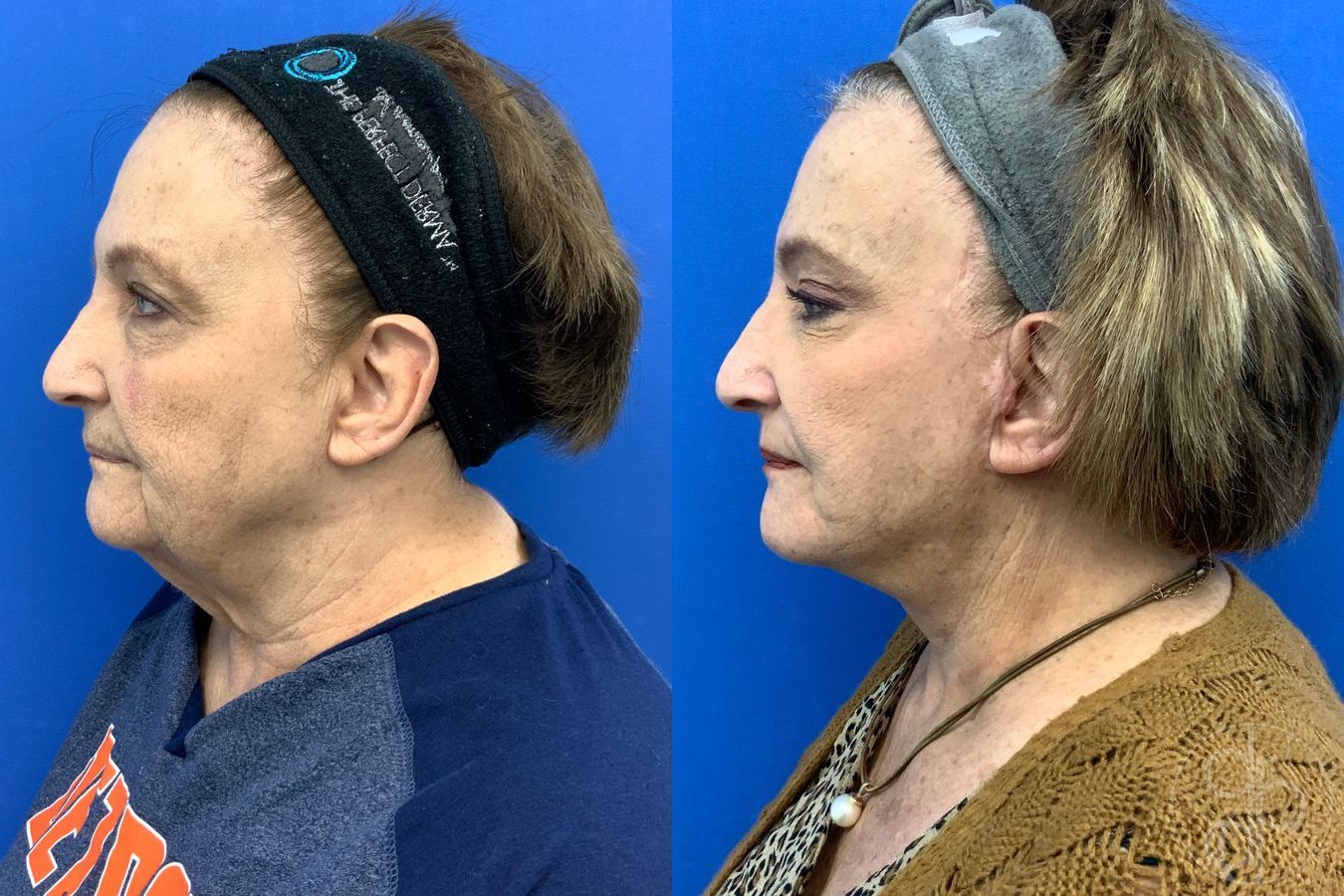 Before and after Facelift case 43472 - Angle 4