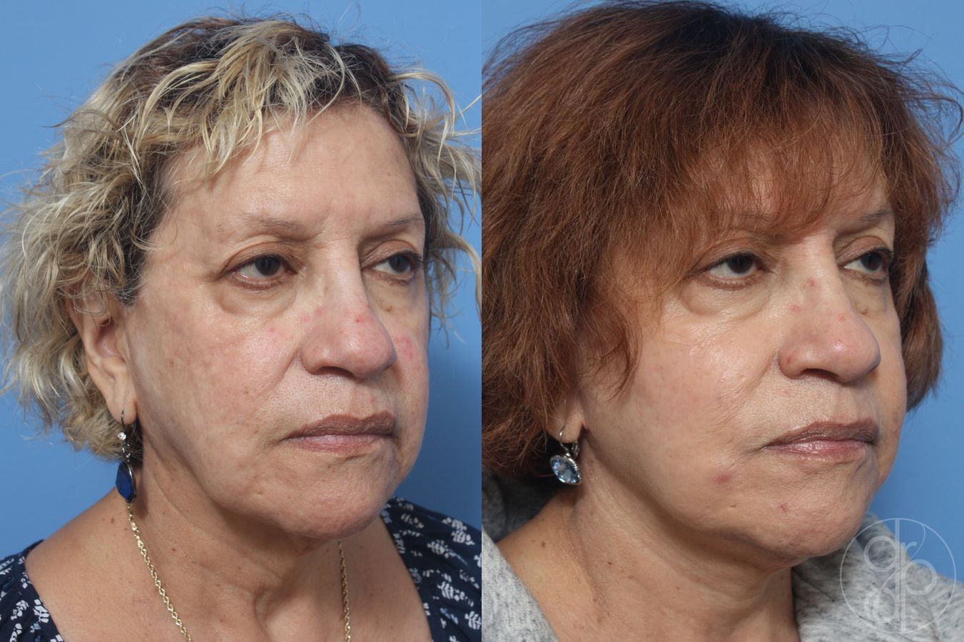 Before and after Facelift case 29842 - Angle 5