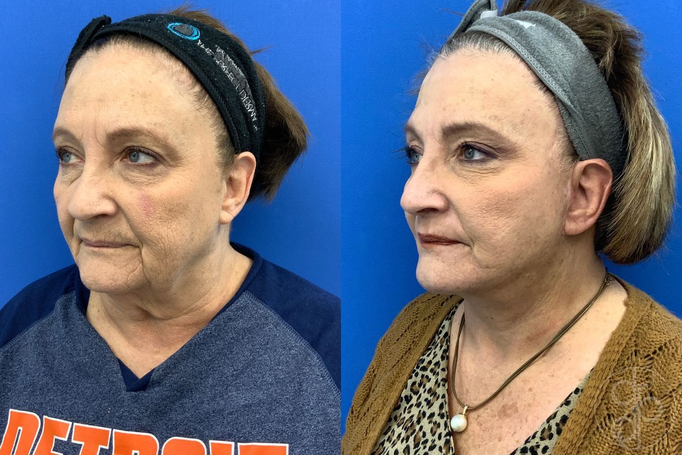 Before and after Facelift case 43472 - Angle 3