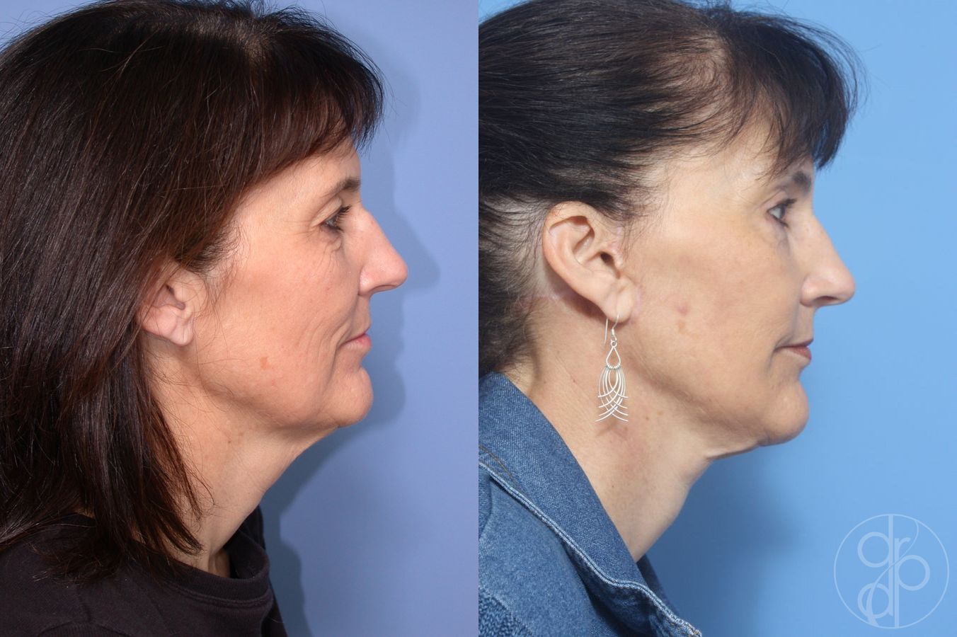 Before and after Facelift case 29813 - Angle 2