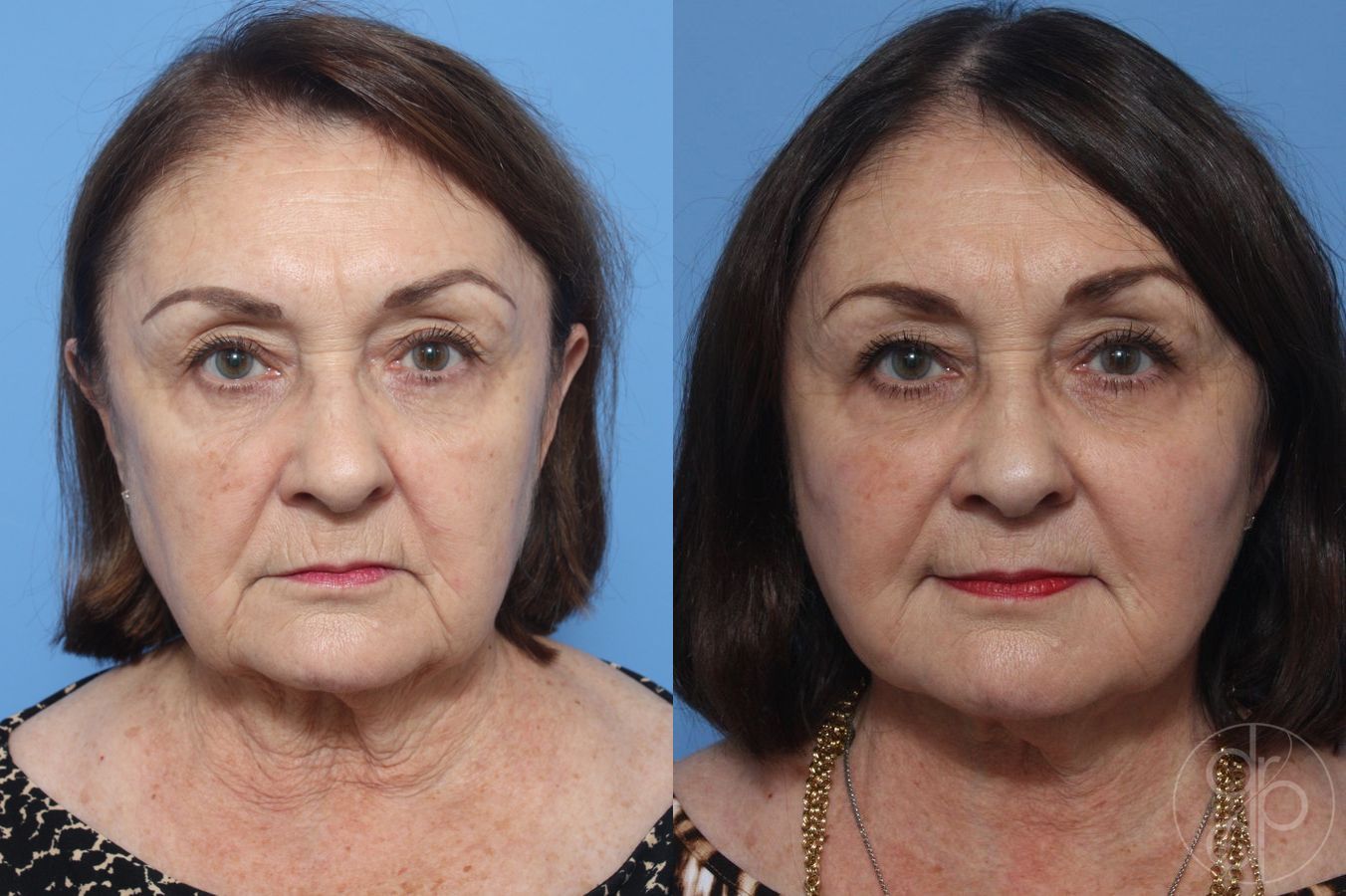 Before and after Facelift case 29843