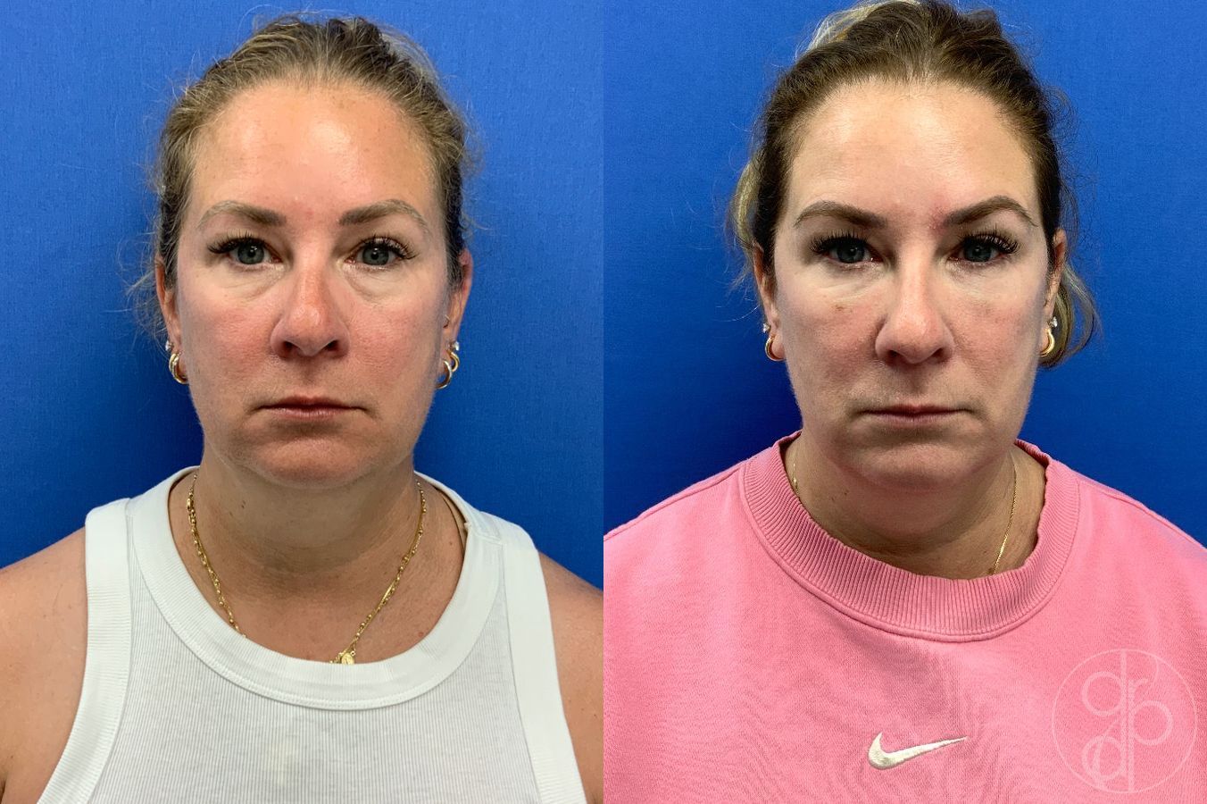 Before and after Injectables case 46421