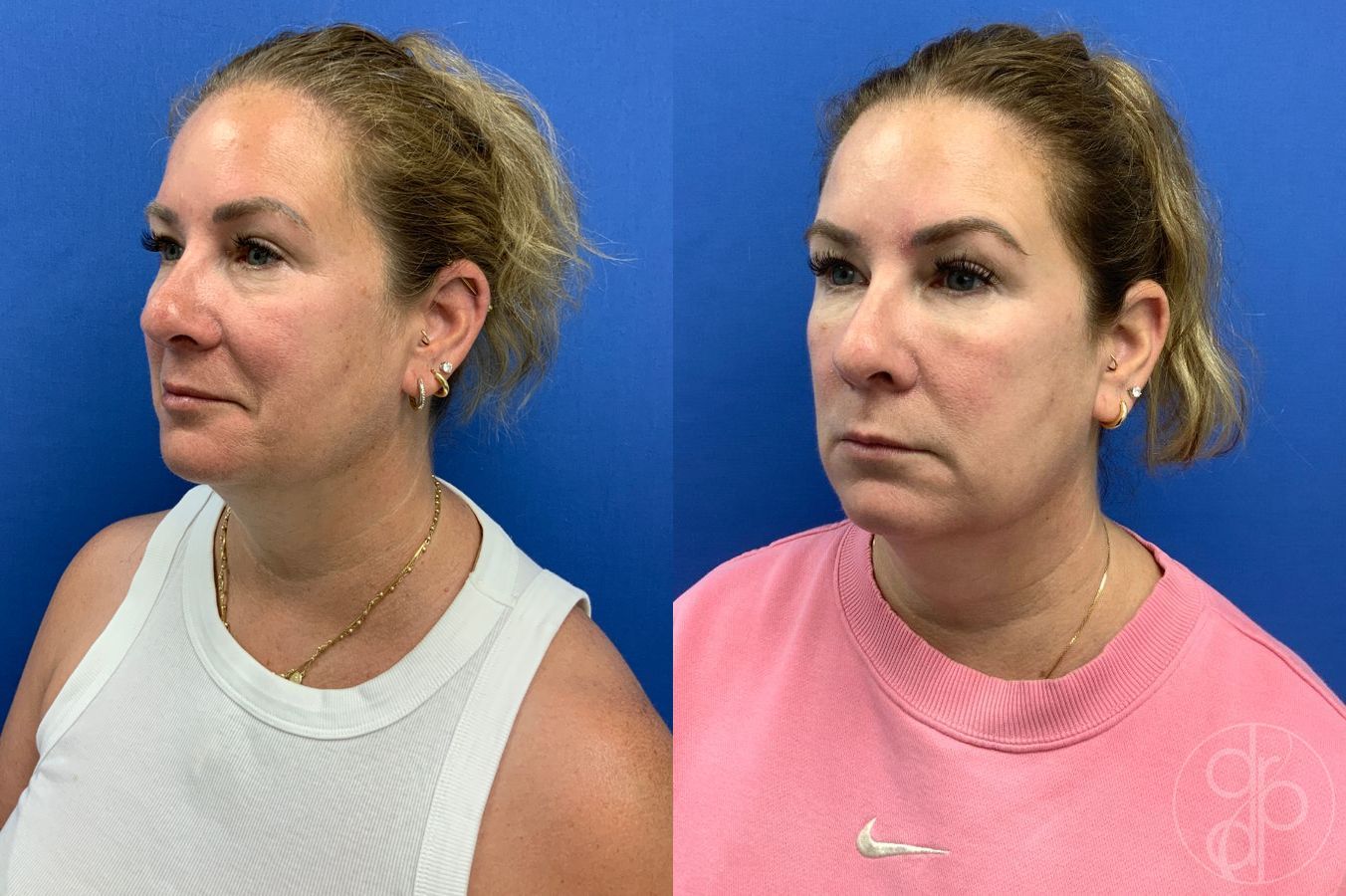 Before and after Injectables case 46421 - Angle 3