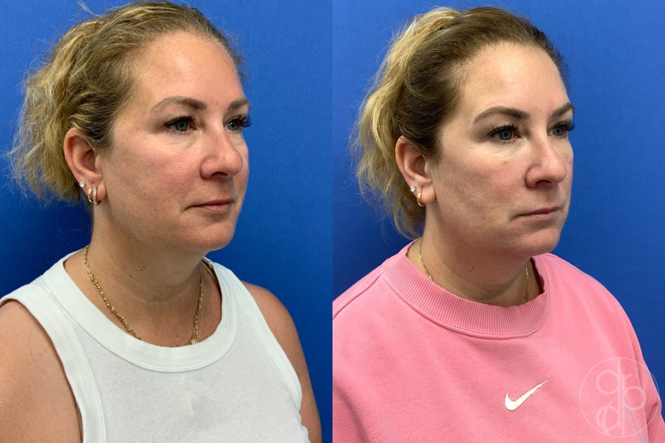 Before and after Injectables case 46421 - Angle 4
