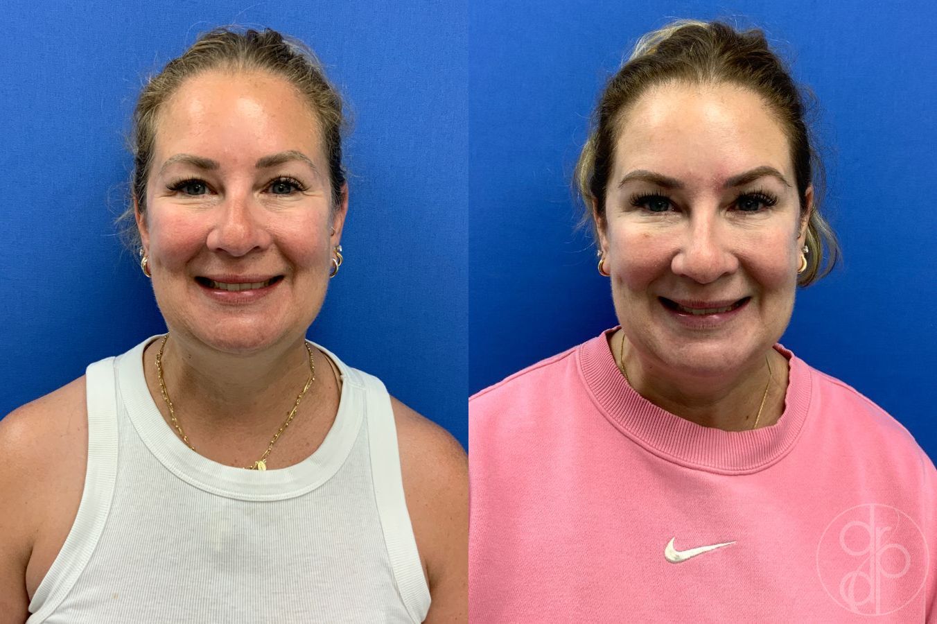 Before and after Injectables case 46421 - Angle 2