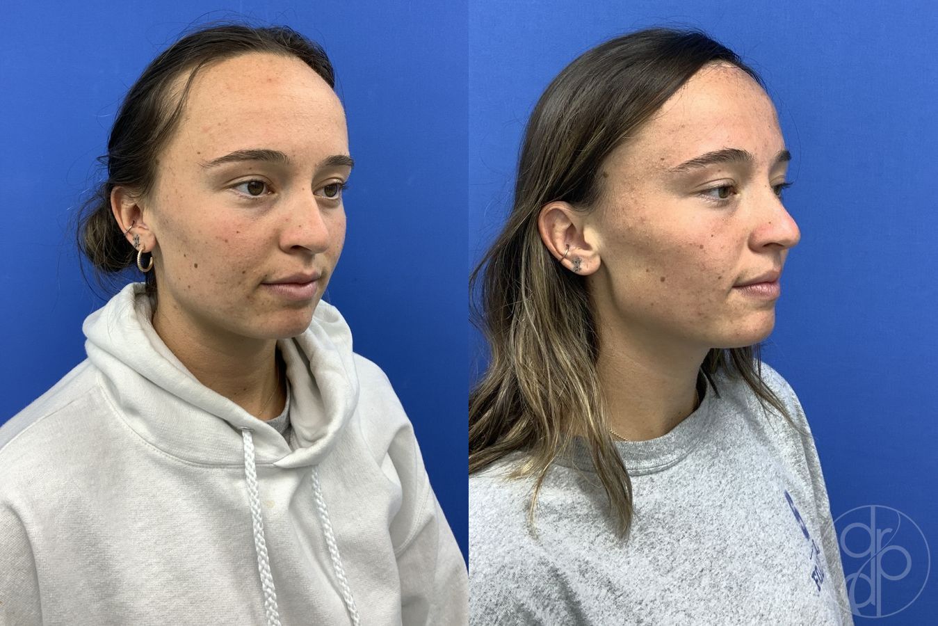 Forehead Reduction - Thumbnail 2