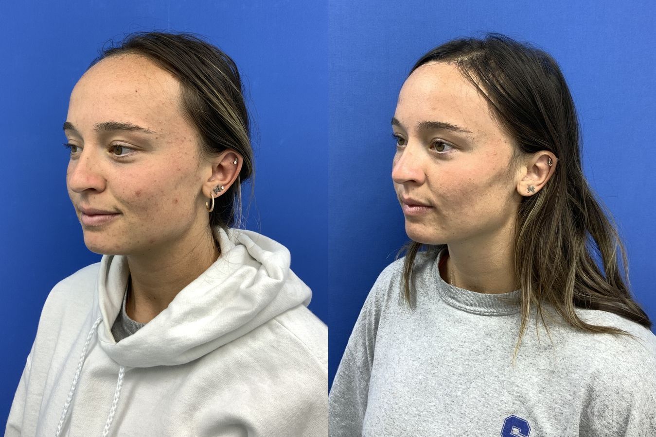 Forehead Reduction - Thumbnail 3