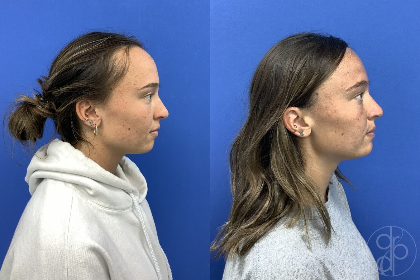 Forehead Reduction - Thumbnail 4