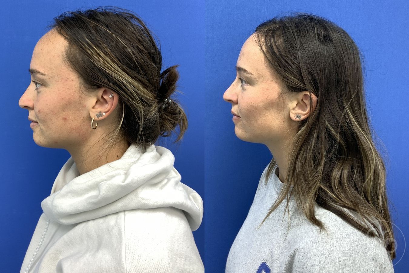 Forehead Reduction - Thumbnail 5