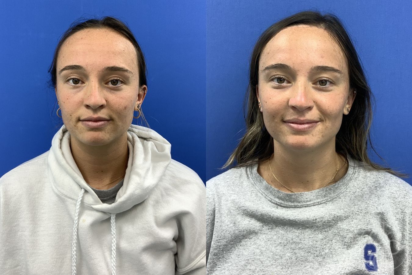 Forehead Reduction - Case 584