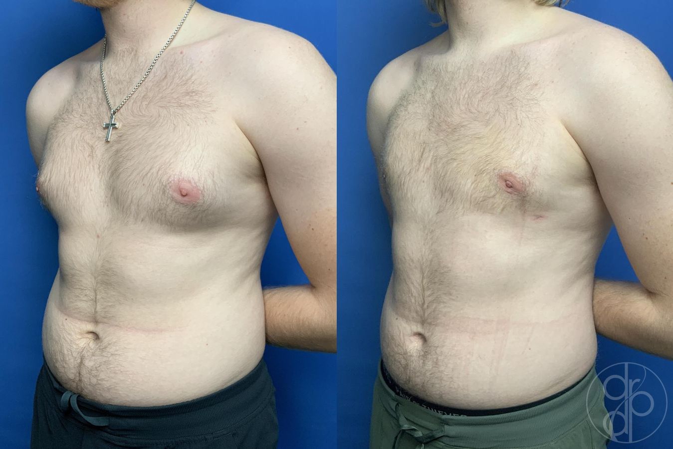 Before and after Gynecomastia case 29997 - Angle 3