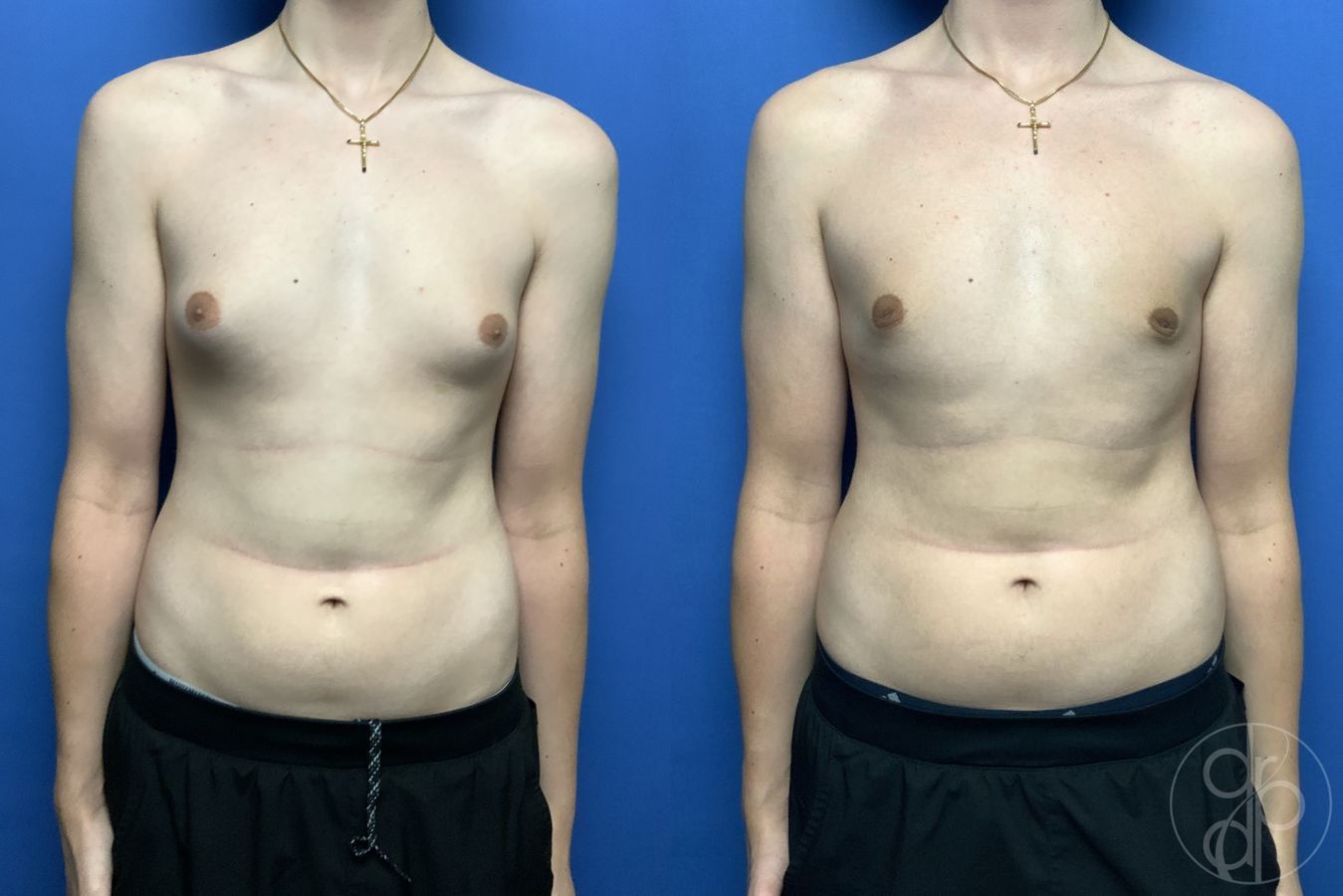 Gynecomastia - Case 535
