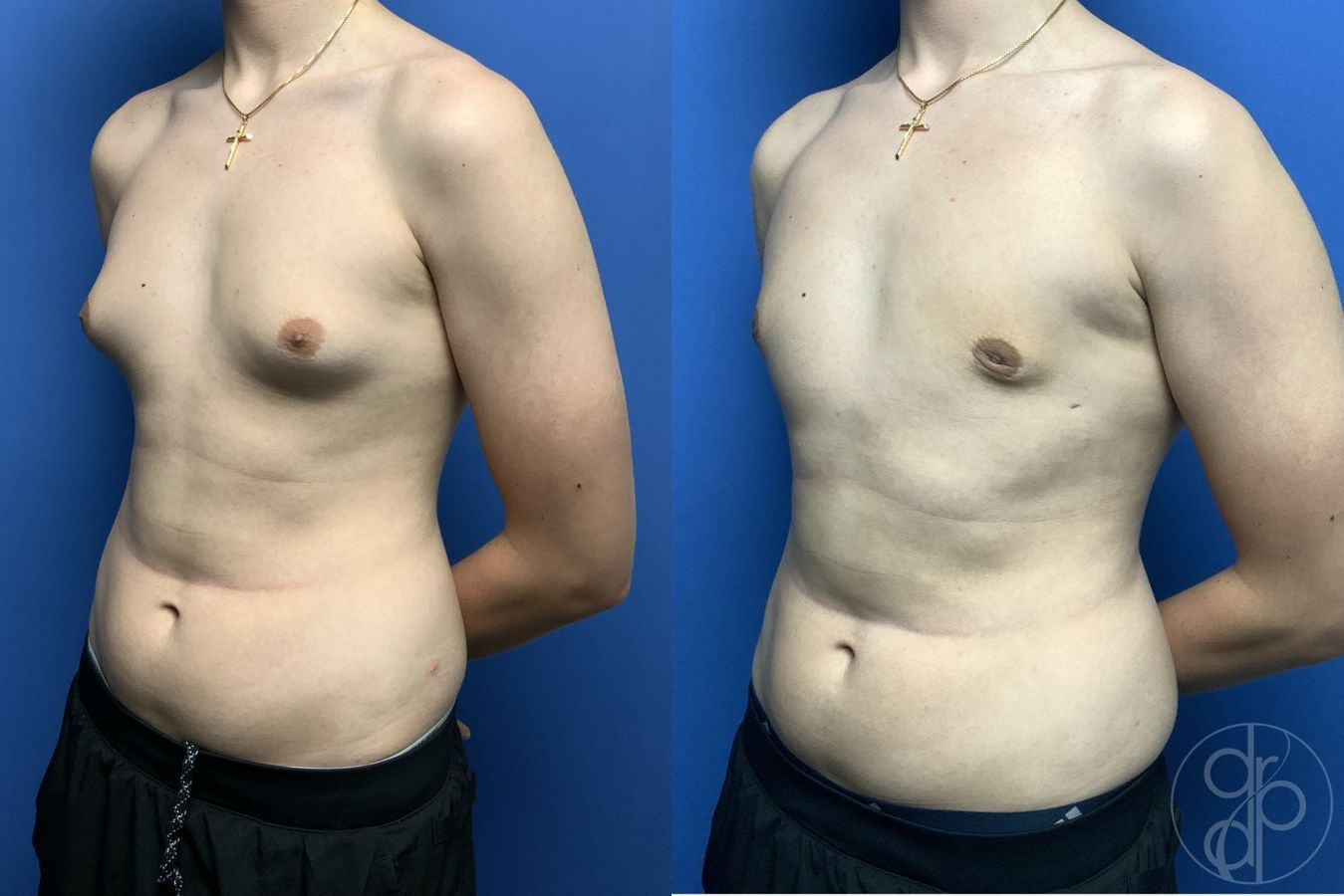 Before and after Gynecomastia case 29811 - Angle 3