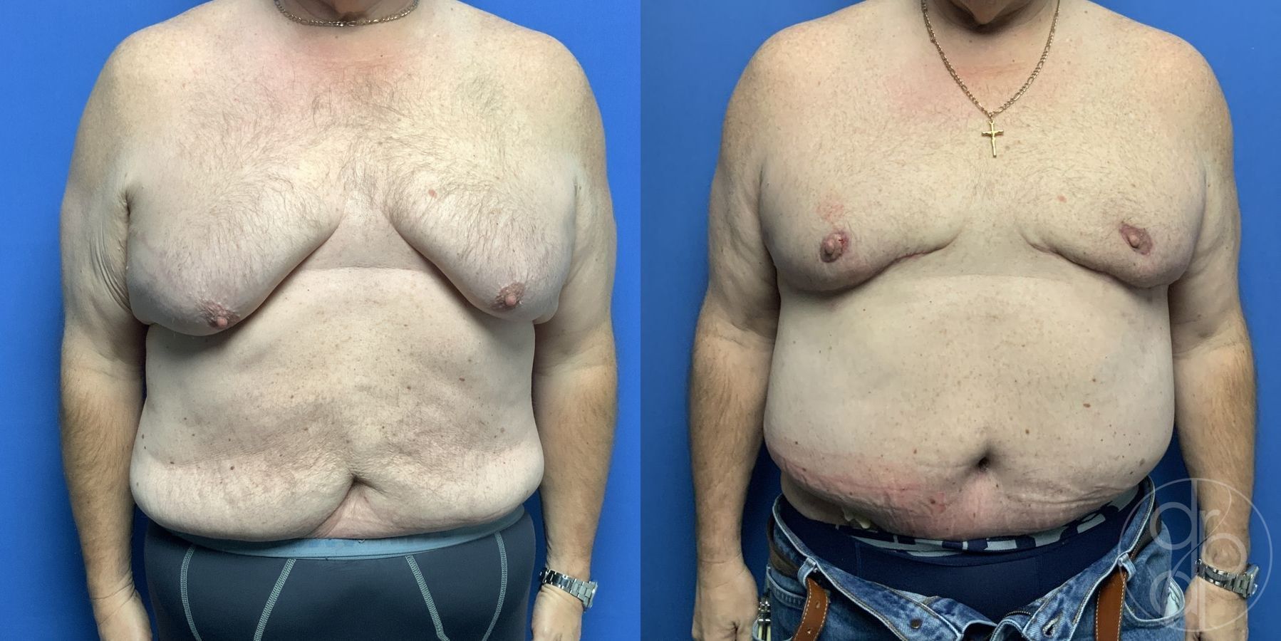 Before and after Gynecomastia case 29865