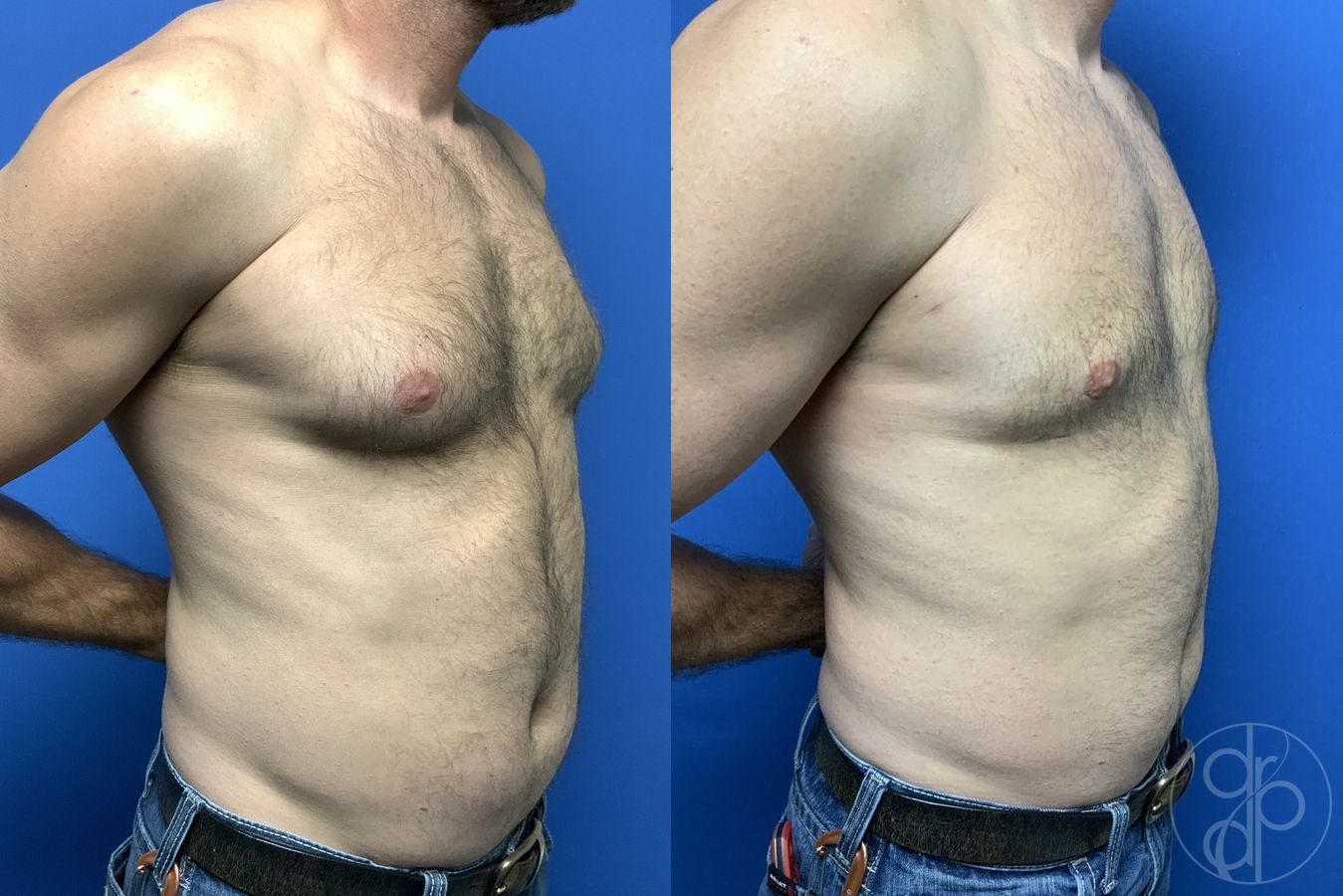 Before and after Gynecomastia case 29758 - Angle 2