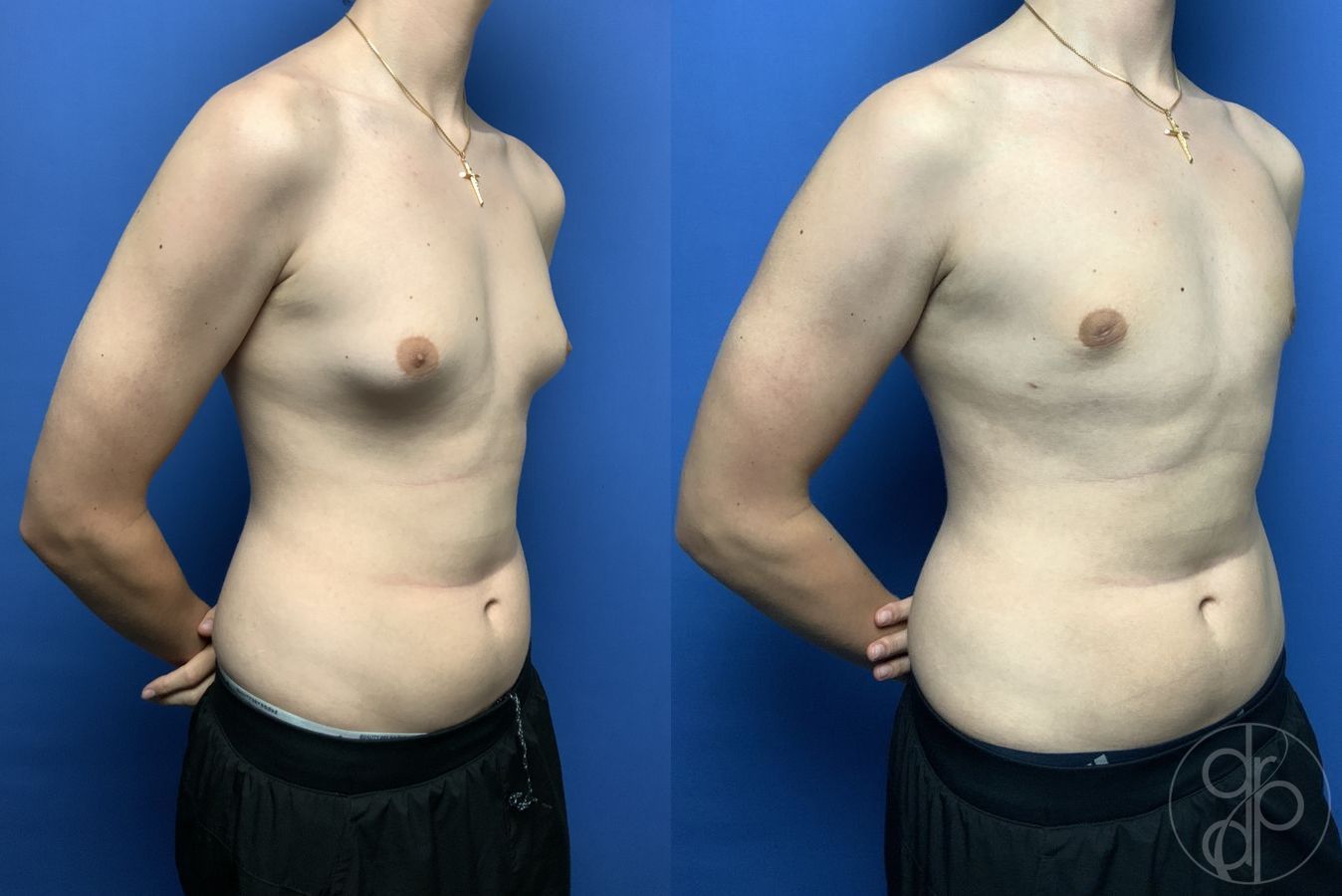 Before and after Gynecomastia case 29811 - Angle 2