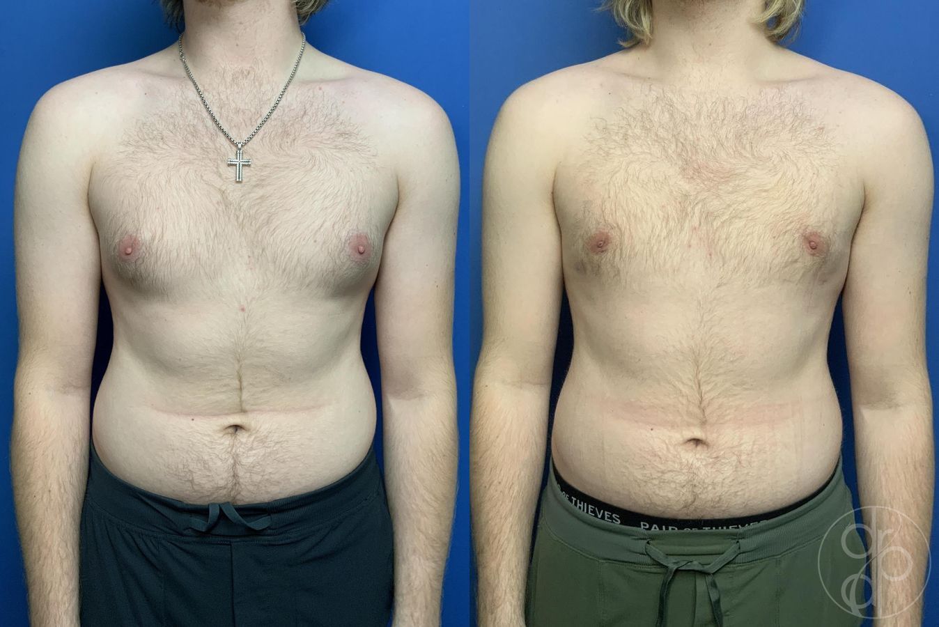 Before and after Gynecomastia case 29997