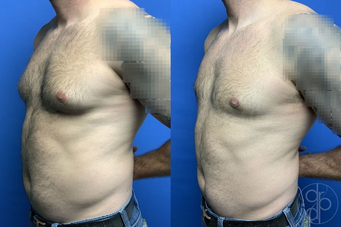 Before and after Gynecomastia case 29758 - Angle 3