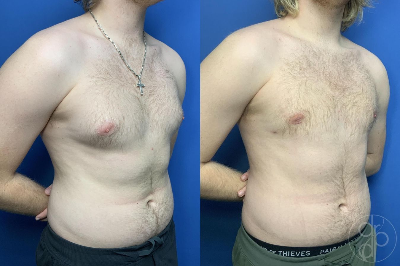 Before and after Gynecomastia case 29997 - Angle 2