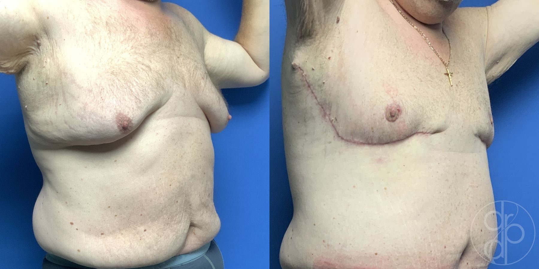 Before and after Gynecomastia case 29865 - Angle 2