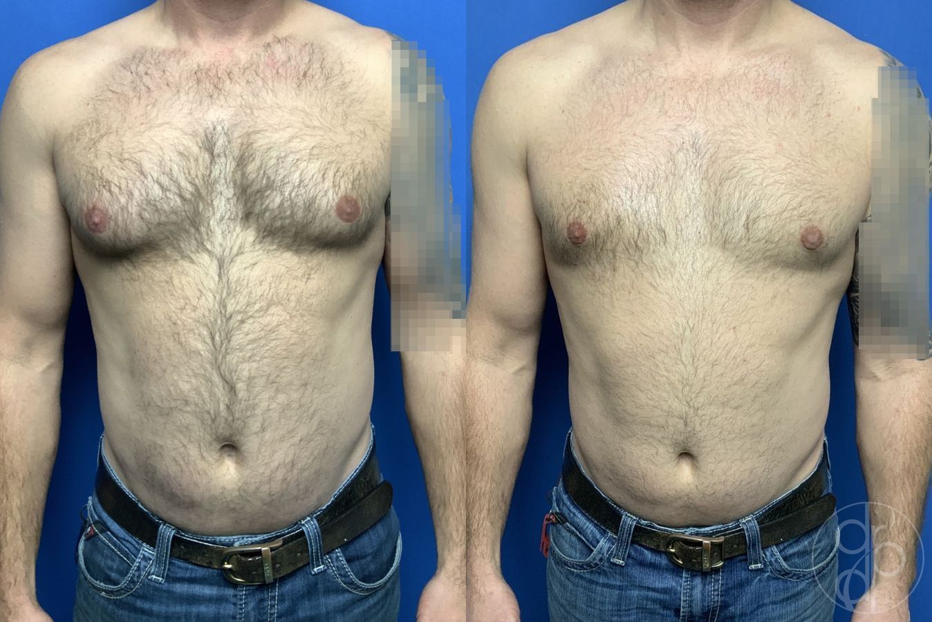 Before and after Gynecomastia case 29758